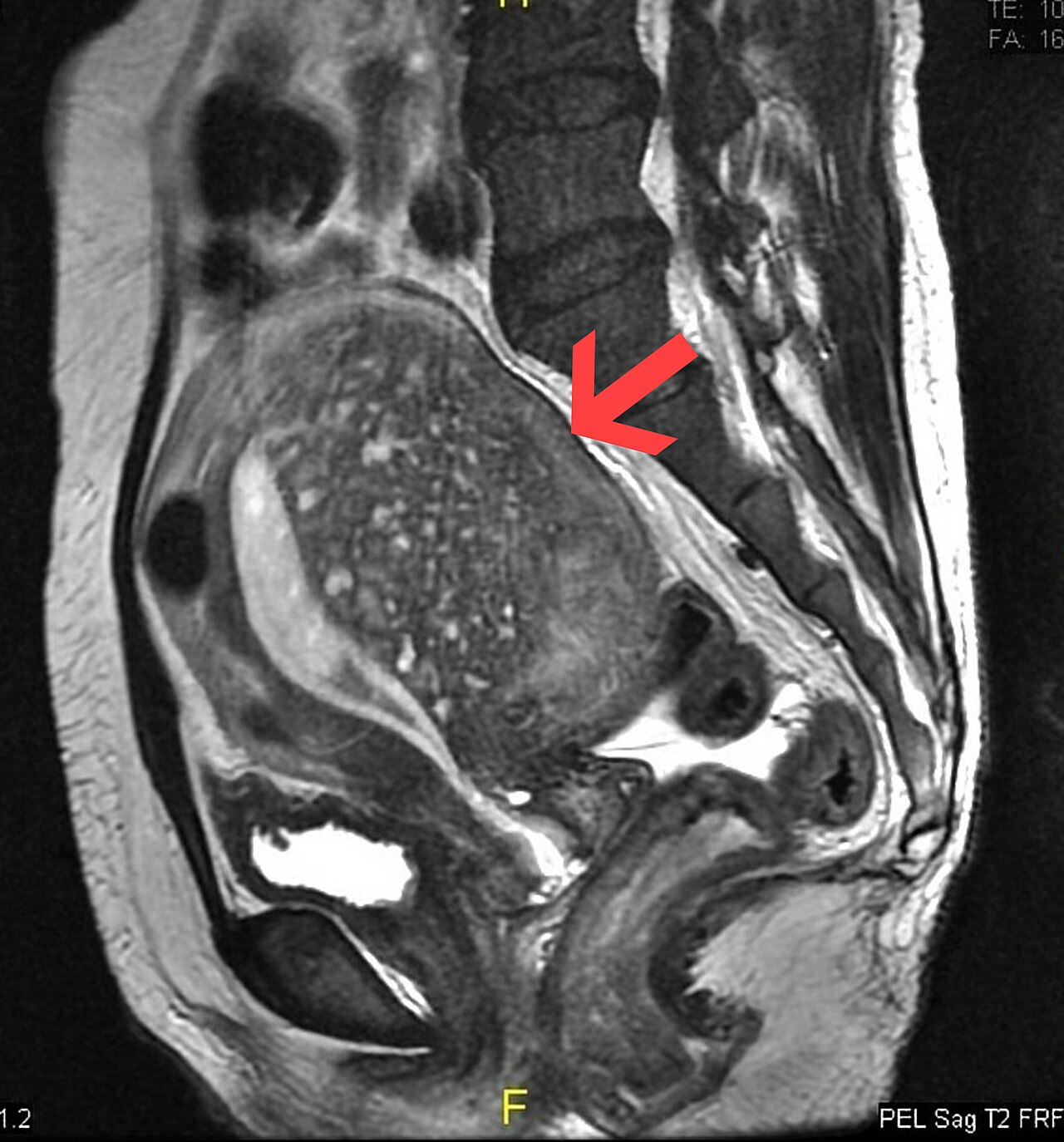 Adenomiosis uterina