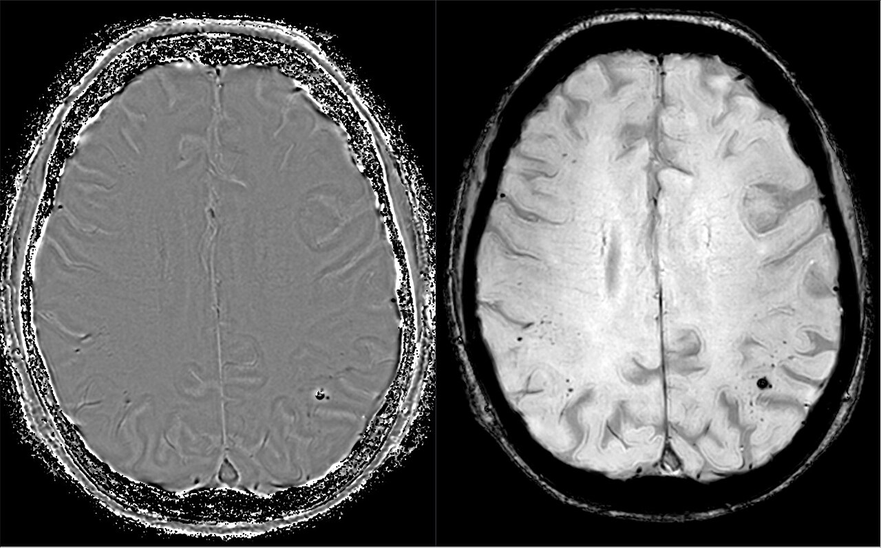 Angiopatía amiloide cerebral