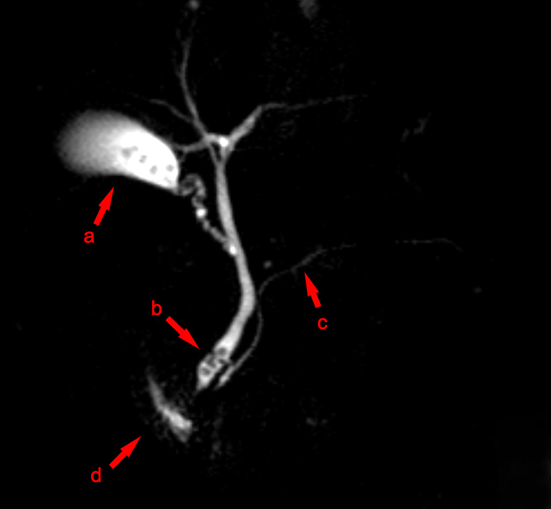 Coledocolitiasis