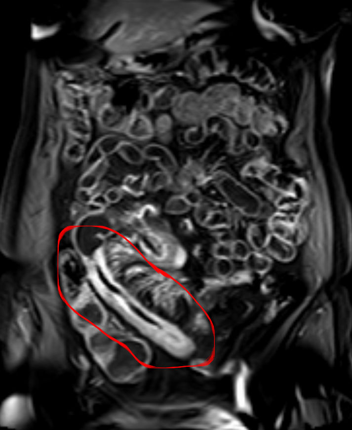 Enfermedad de Crohn