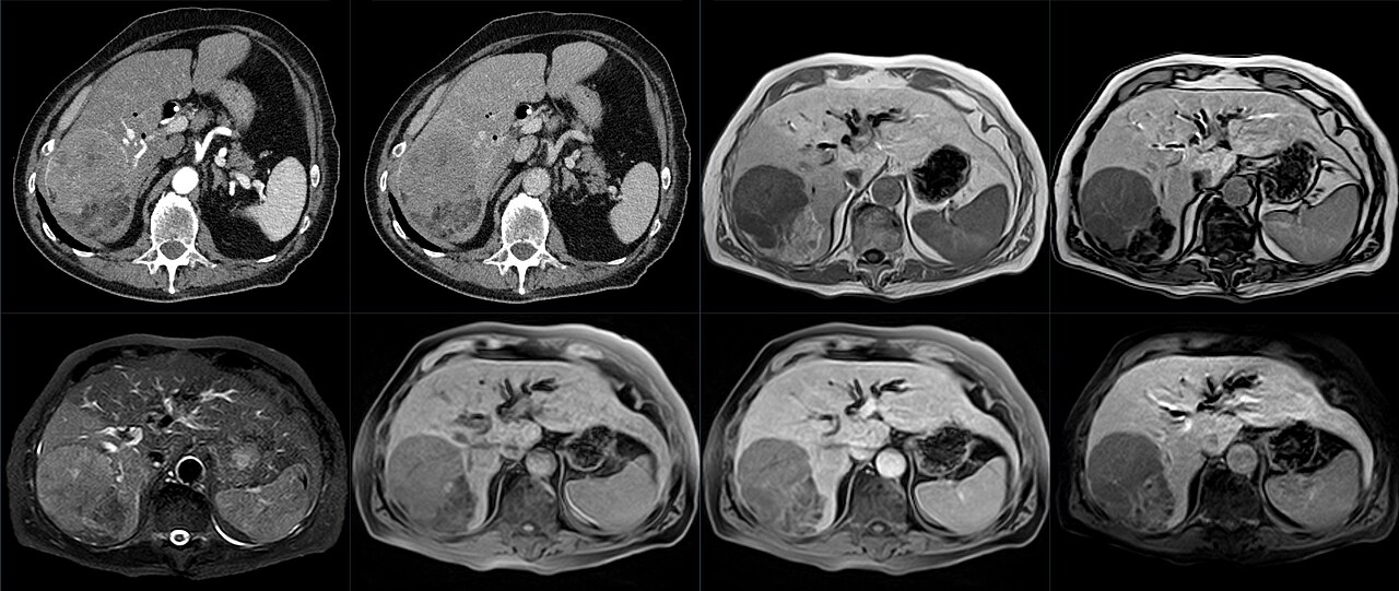 Hepatocarcinoma