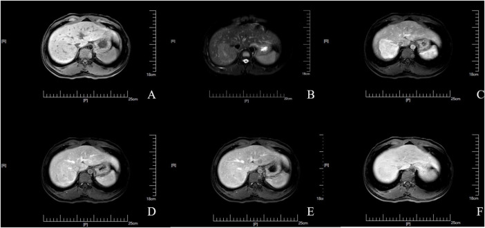 Hiperplasia nodular focal