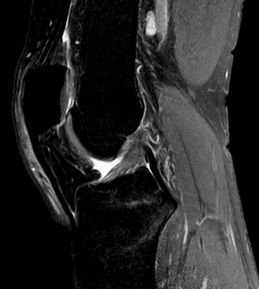 Rotura del ligamento cruzado anterior