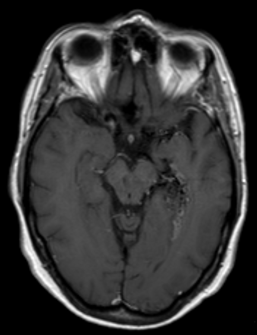 Malformación arteriovenosa cerebral