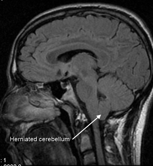Malformación de Chiari de tipo I