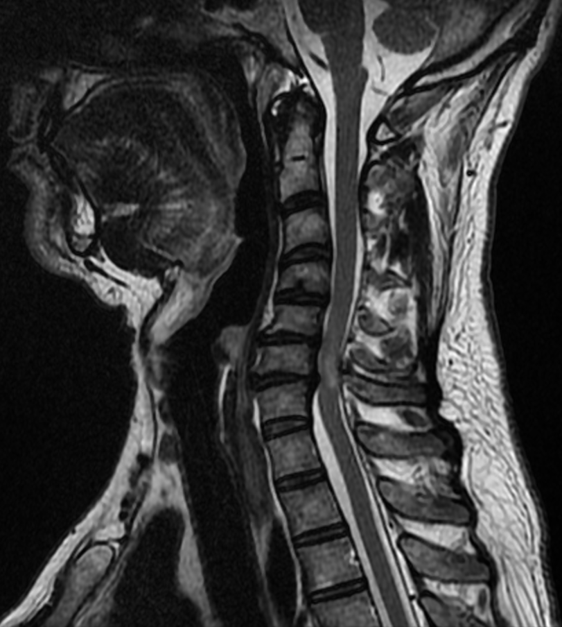 Mielopatía espondilótica cervical