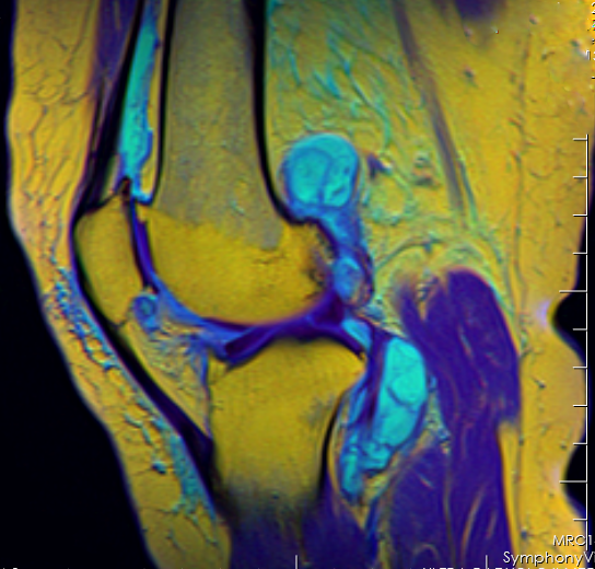 Resonancia magnética de rodilla