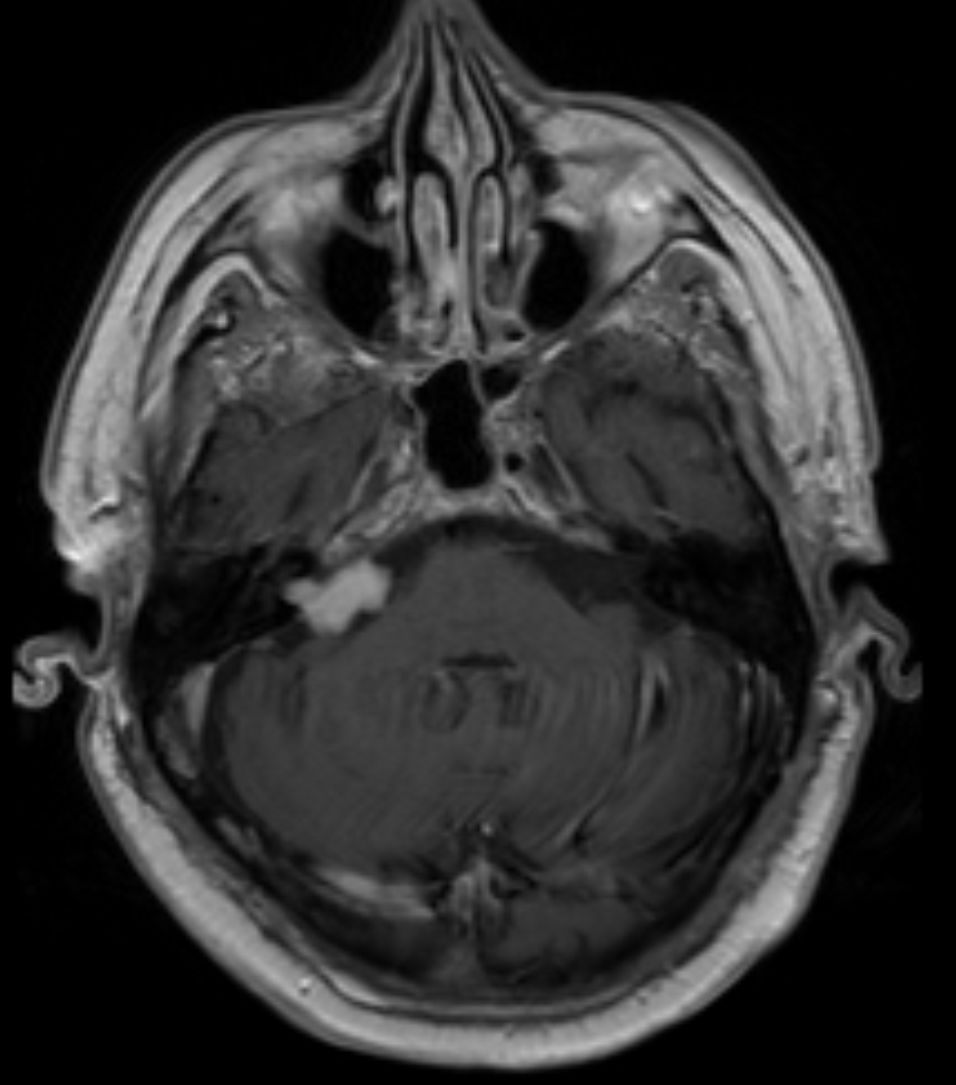 Schwannoma vestibular