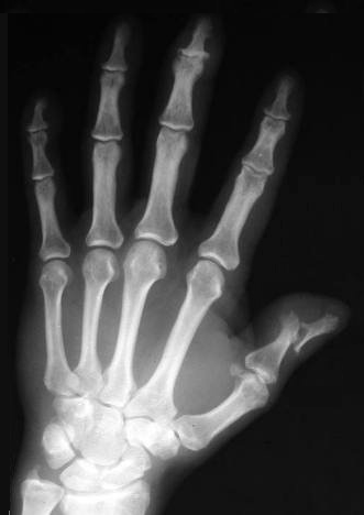 Artritis psoriásica