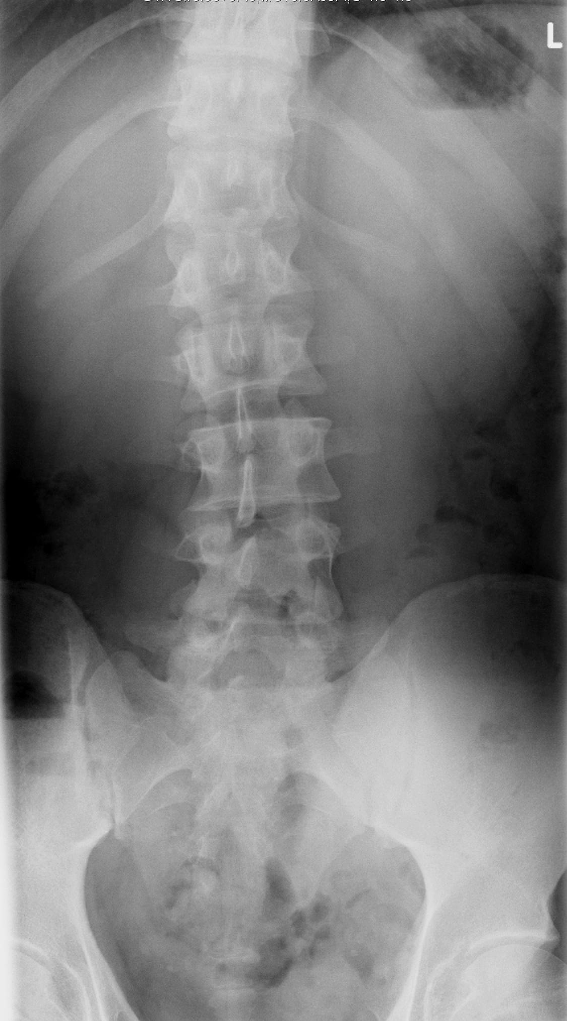 Escoliosis
