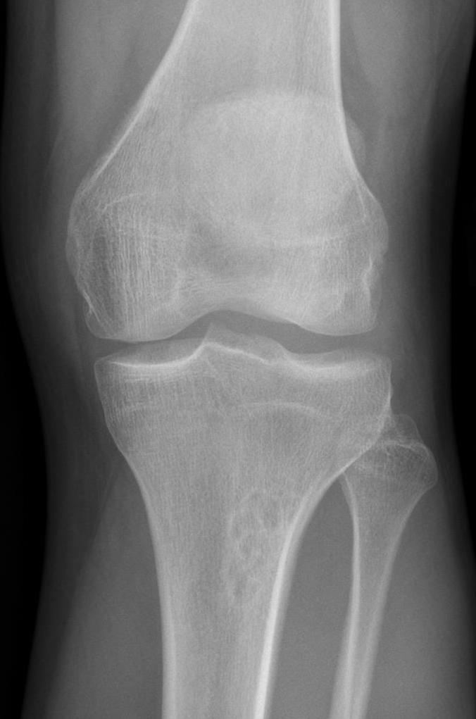 Fibroma no osificante
