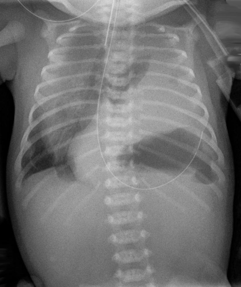 Hernia diafragmática congénita
