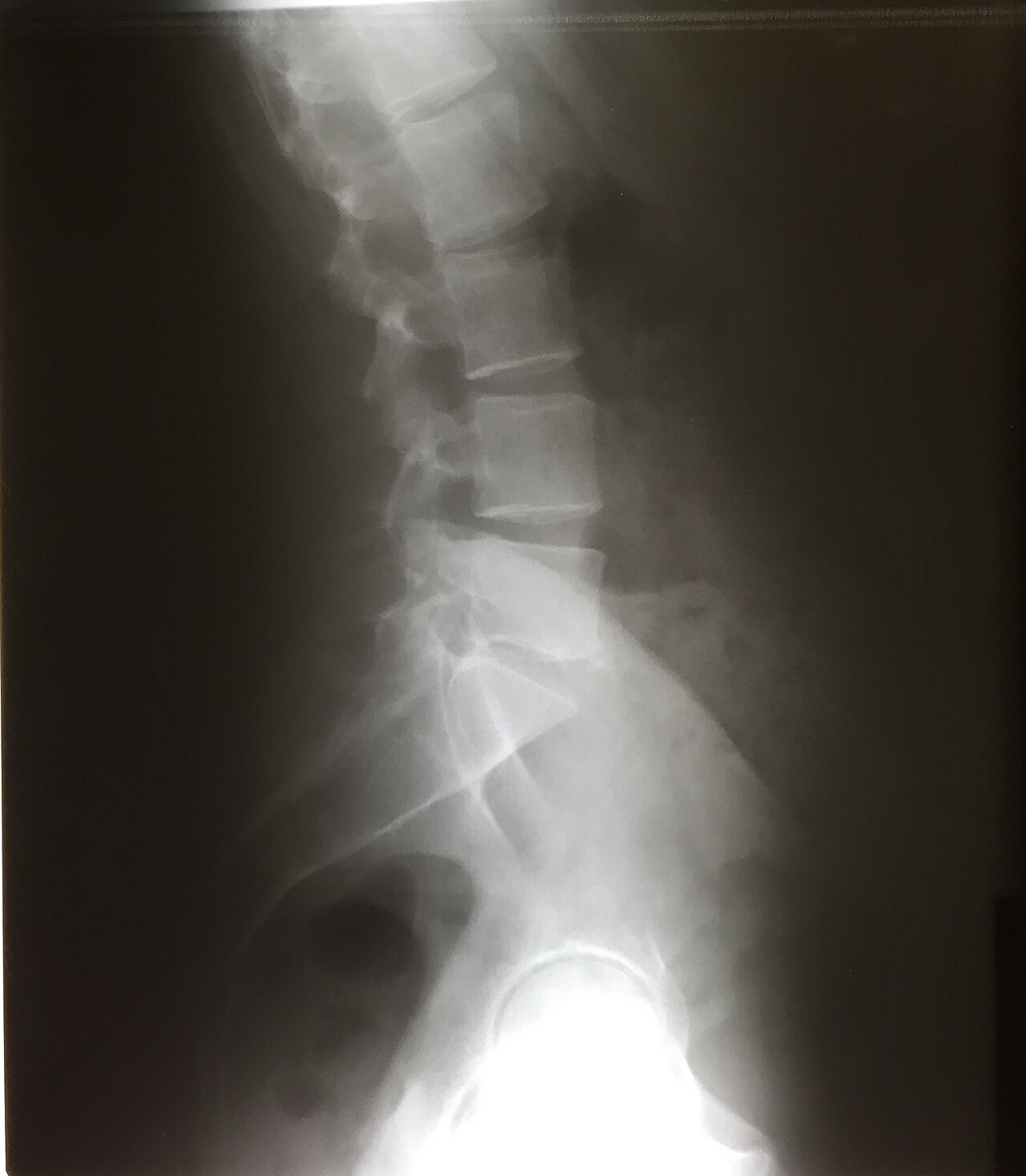 Radiografía lateral de columna lumbar