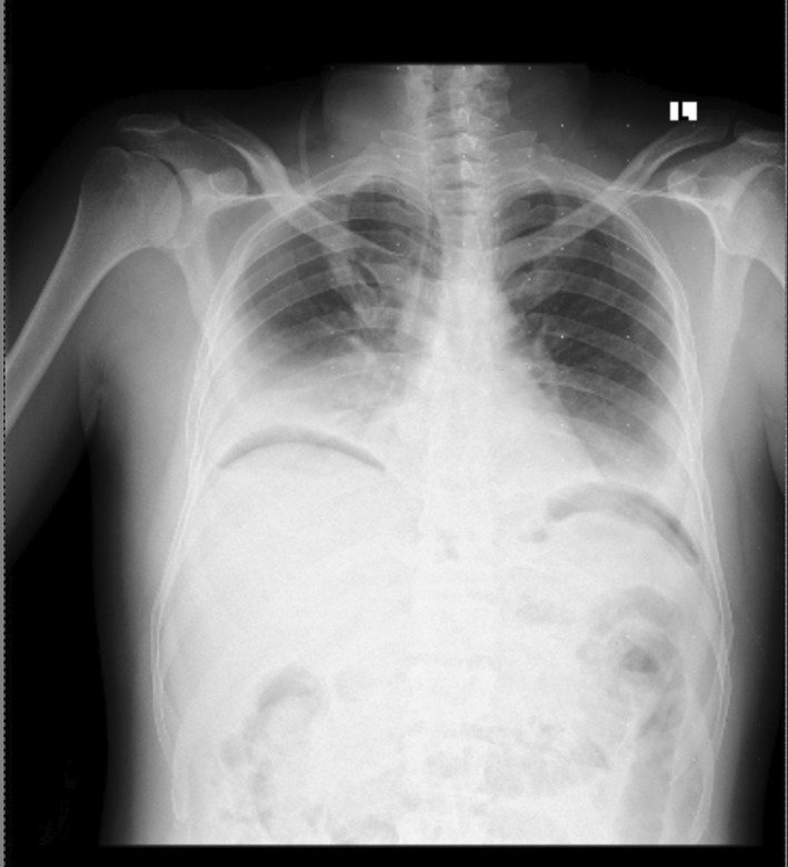 Neumoperitoneo y perforación de víscera hueca