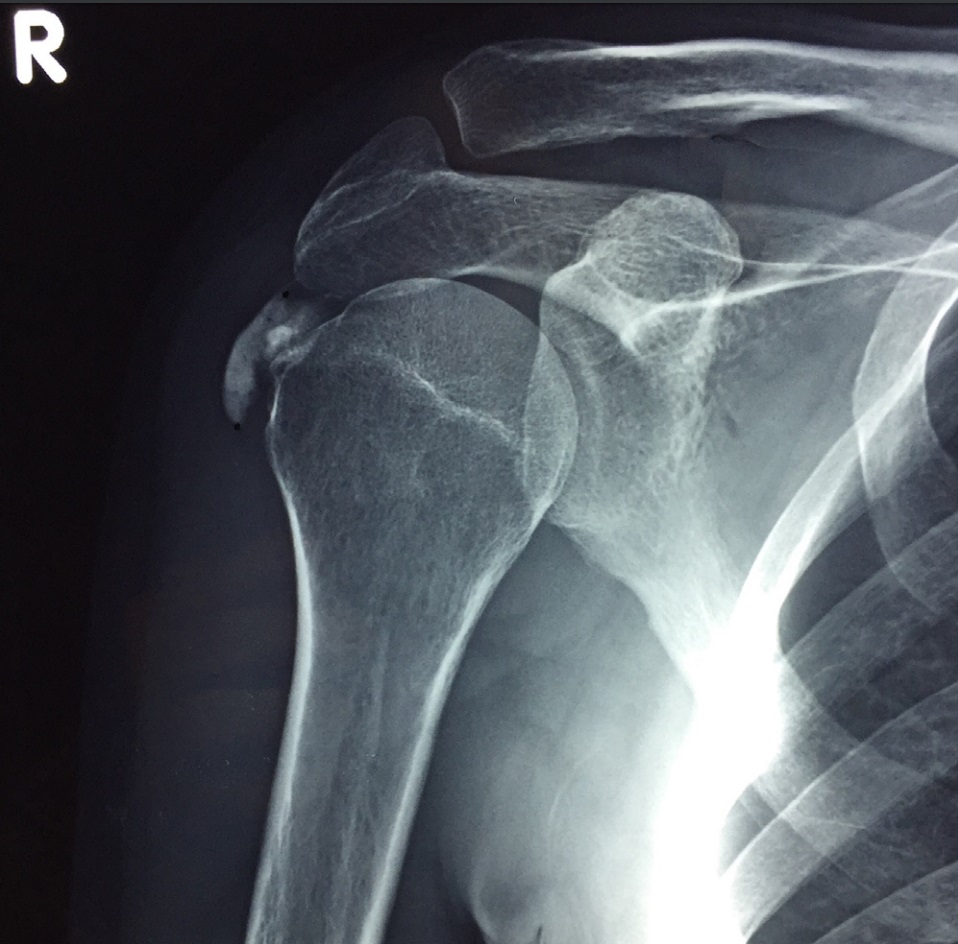 Tendinopatía calcificante del hombro
