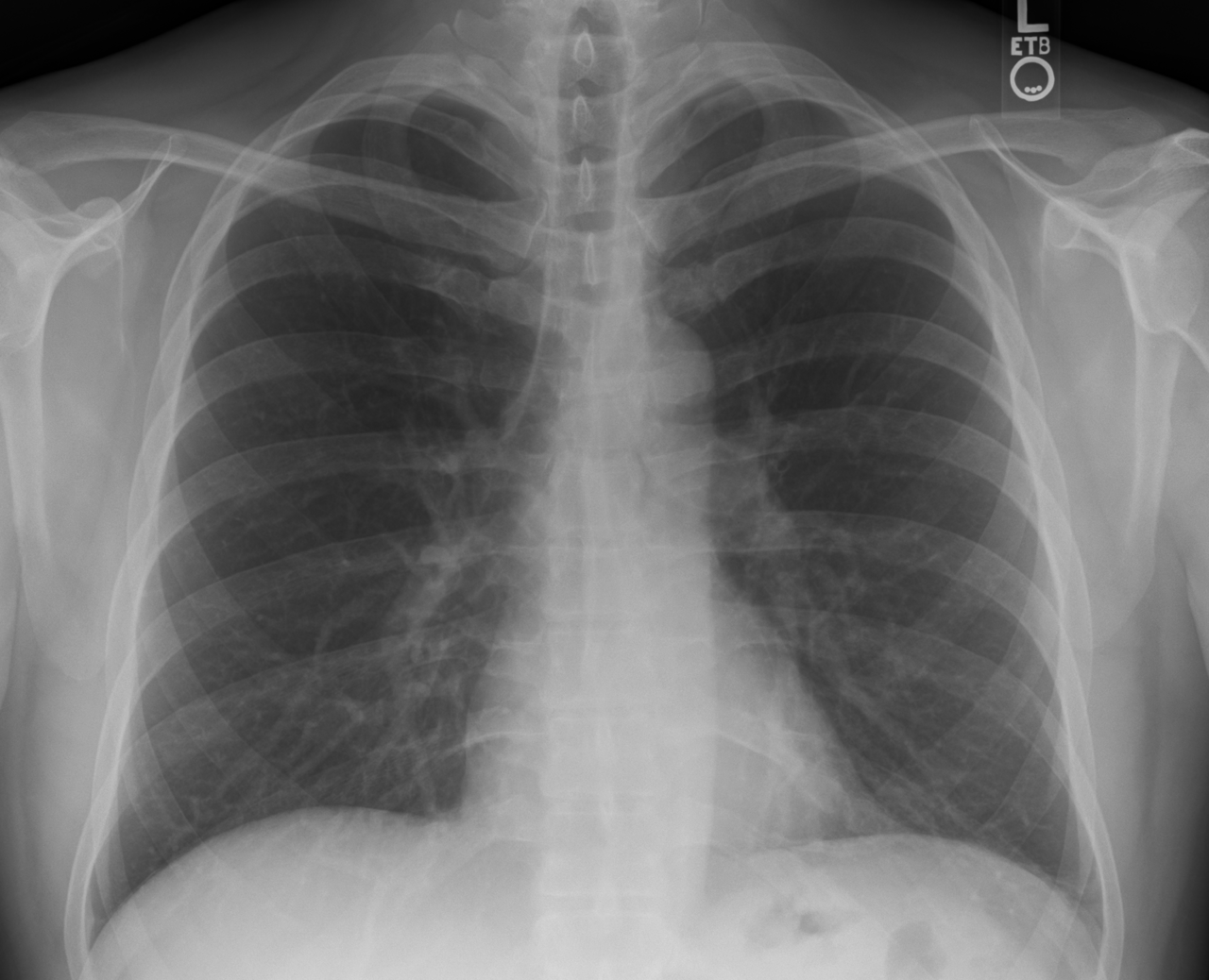 Radiografía de tórax normal (posteroanterior)