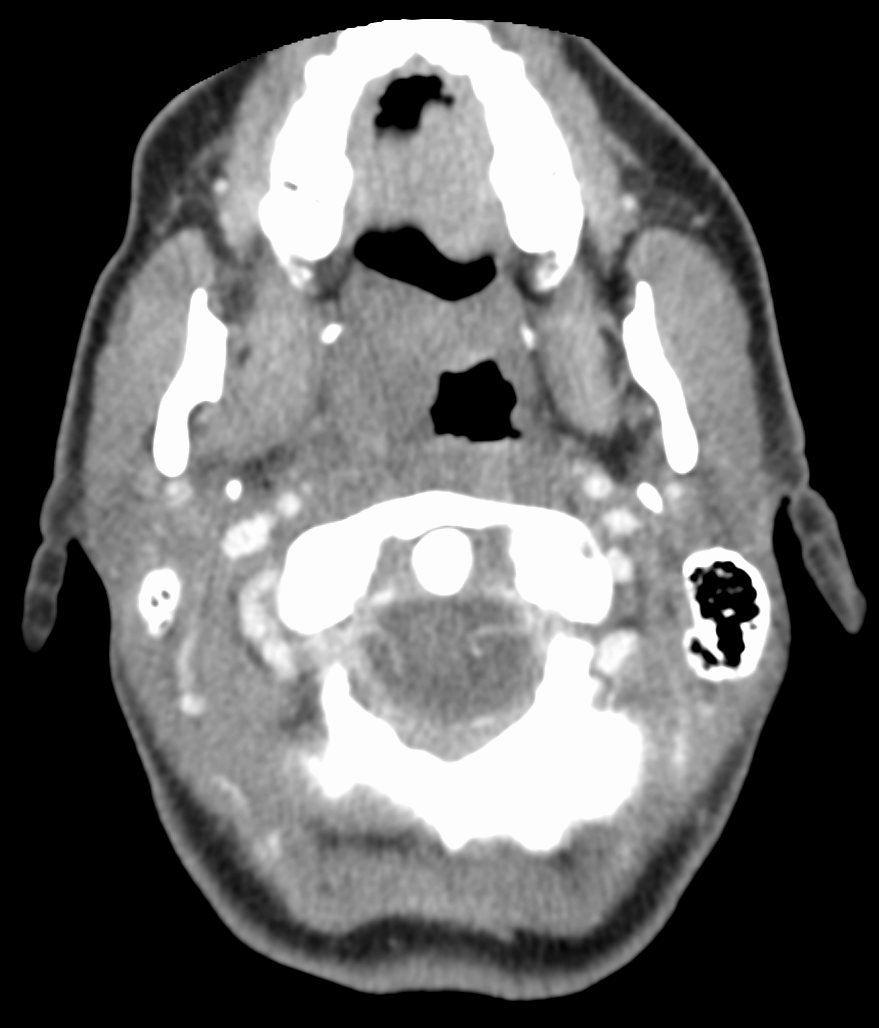Absceso periamigdalino
