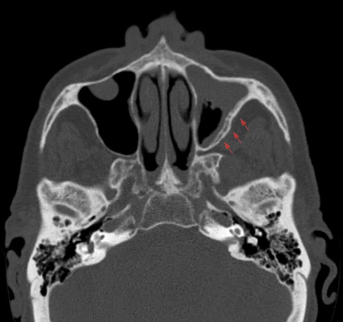 Tomografía axial en ventana ósea con ocupación del seno maxilar izquierdo y engrosamiento esclerótico de sus paredes (flechas), signo de cronicidad.