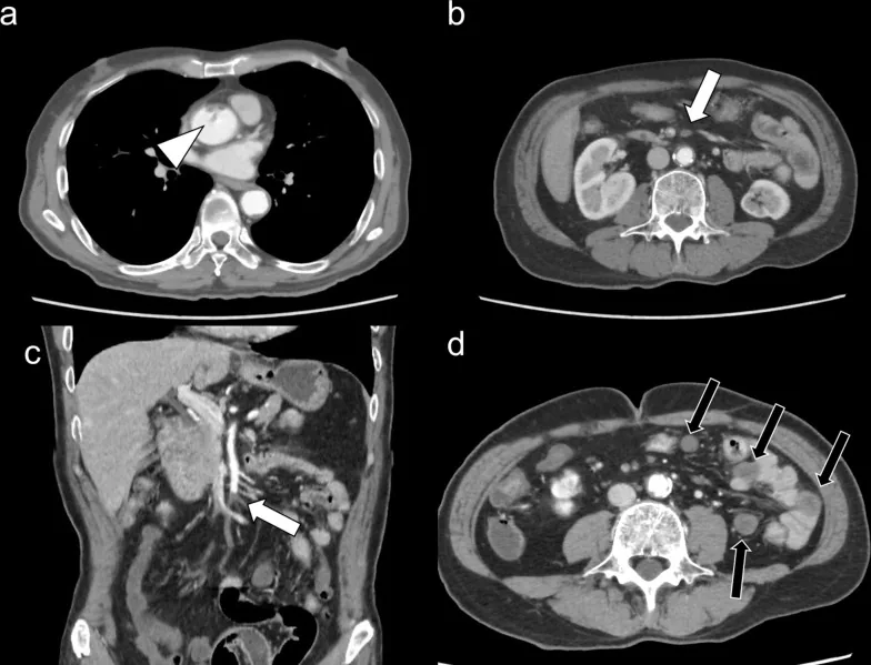 Tomografía con contraste en cuatro paneles: Trombo flotante en la aorta ascendente, defecto de repleción en la arteria mesentérica superior en cortes axial y coronal, y menor realce de las asas de intestino delgado.