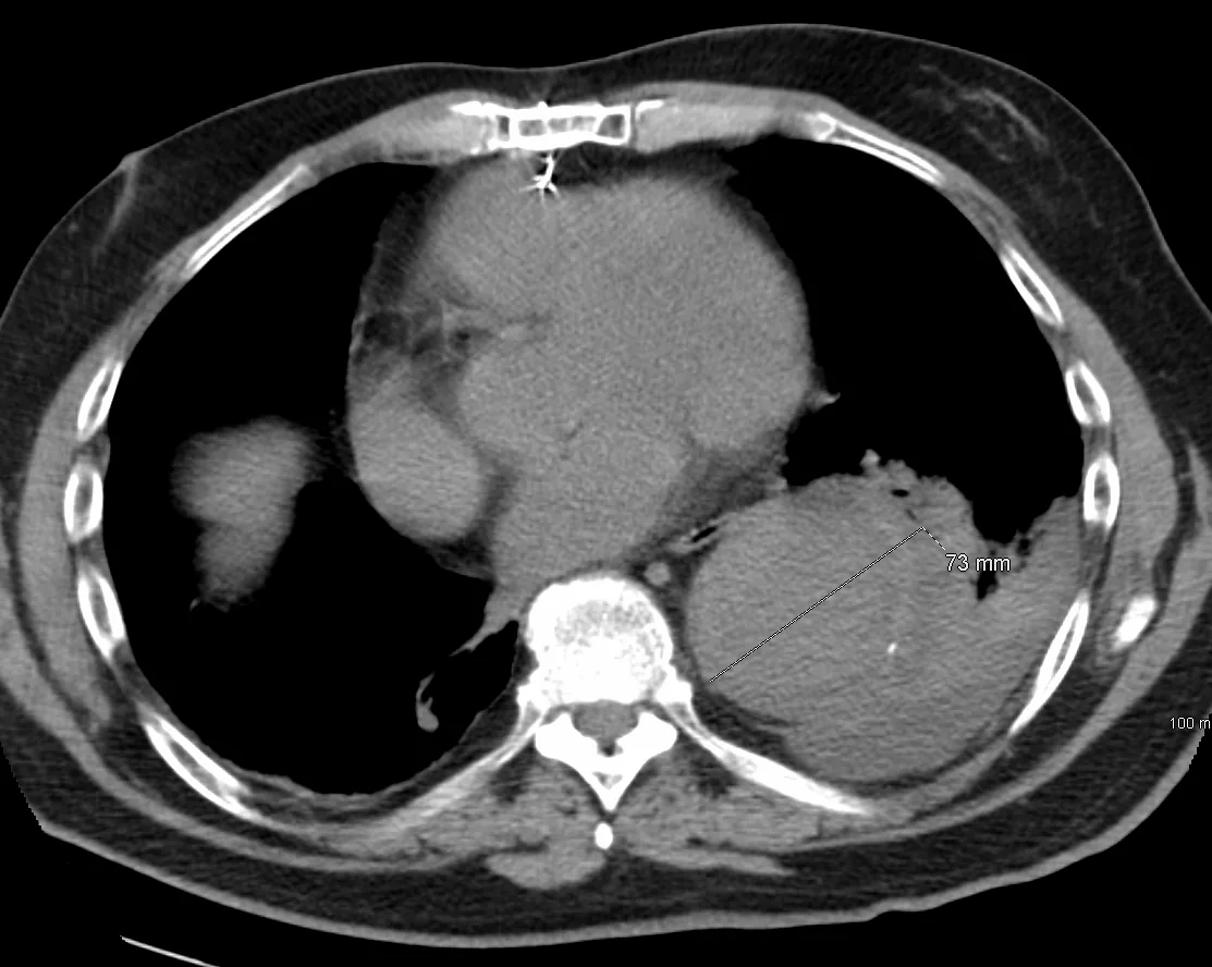 Tomografía axial de tórax con la aorta descendente muy dilatada, de unos 7 cm medidos en la imagen, con trombo mural y calcificación de la pared.
