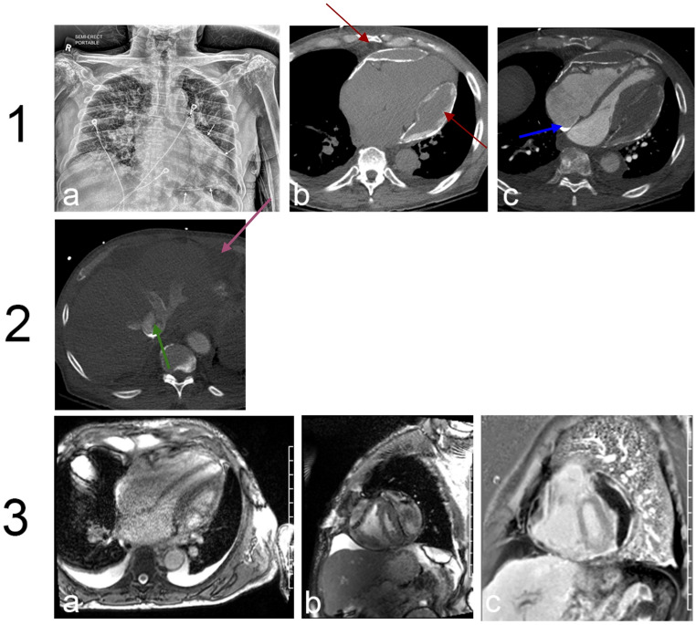 Pericarditis constrictiva