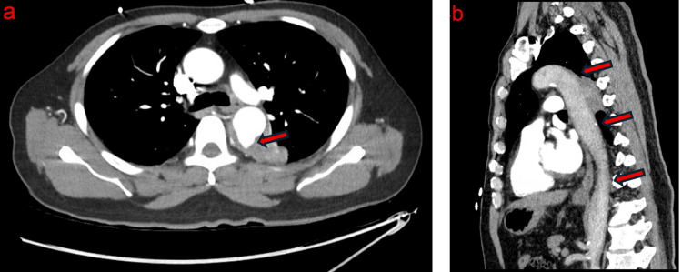 Úlcera aterosclerótica penetrante de la aorta