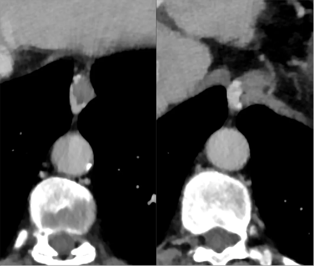 Tomografía axial con contraste en fase portal con estructuras vasculares serpiginosas que realzan en la pared y alrededor del esófago distal.