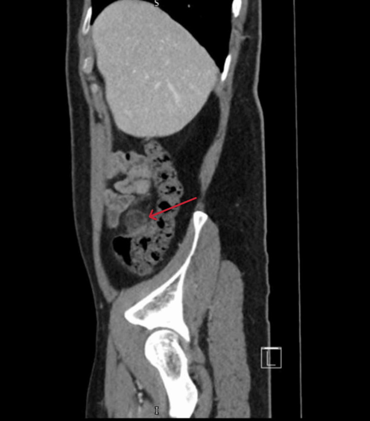 Apendagitis epiploica