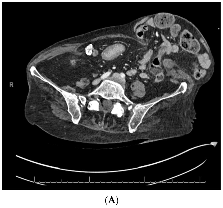 Hernias de la pared abdominal