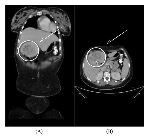 TC abdominal con contraste en cortes coronal y axial: Absceso hepático multiloculado e hipodenso en el segmento IV, con tabiques irregulares y realce periférico, señalado con un círculo y una flecha.