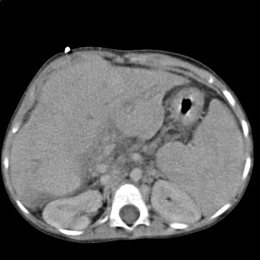 Cirrosis hepática