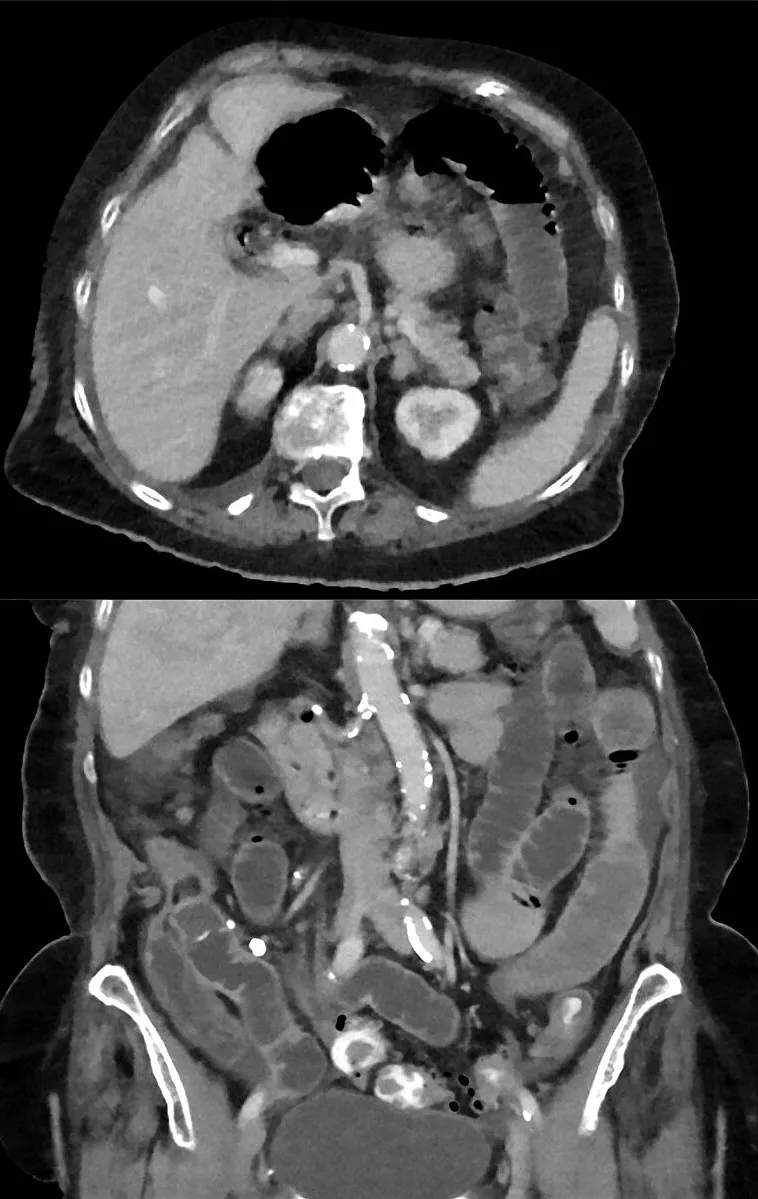 Tomografía con contraste, axial y coronal, de un íleo biliar: Aire en la vía biliar, asas de intestino delgado dilatadas y un cálculo biliar fuera de la vesícula.