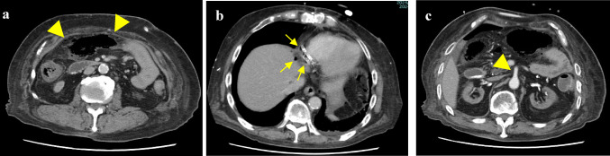 Tres cortes axiales de tomografía con contraste: Realce pobre y gas en la pared del colon ascendente y transverso, gas portal en el hígado y arteria mesentérica superior con realce conservado.