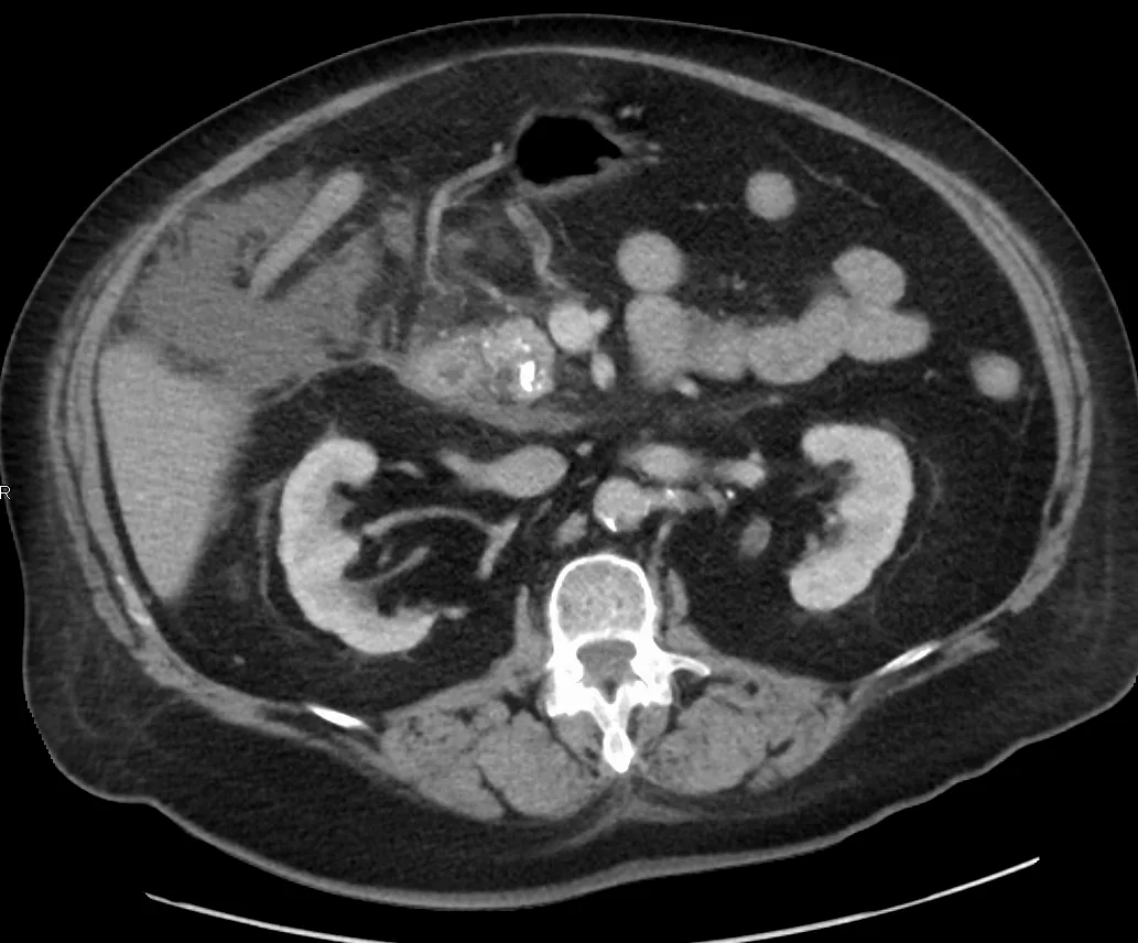 TC axial de abdomen con contraste: Cálculos calcificados en el conducto pancreático de la cabeza del páncreas, propios de la pancreatitis crónica, con algo de líquido libre en el abdomen.