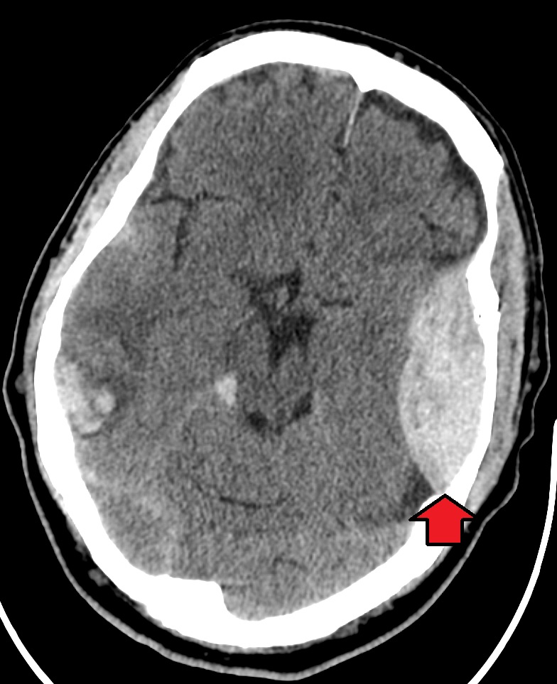 Hematoma epidural