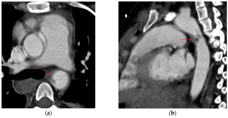Hematoma intramural aórtico