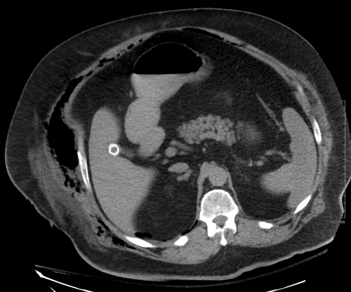 Fascitis necrosante