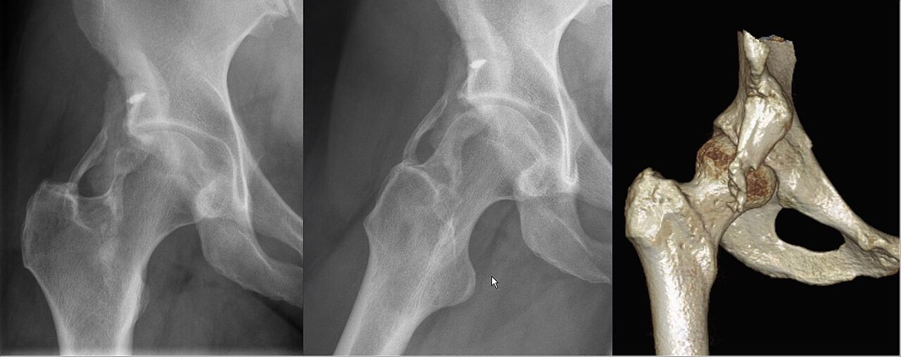 Miositis osificante