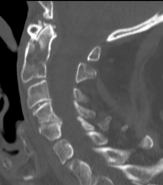 Tomografía sagital de la columna cervical alta con un trazo de fractura que atraviesa la base de la apófisis odontoides y se extiende al cuerpo del axis (tipo III).