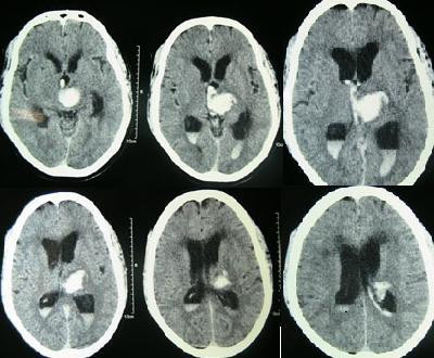 Hemorragia intracerebral