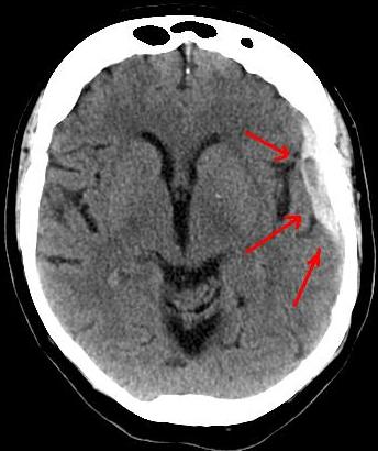 Hematoma subdural