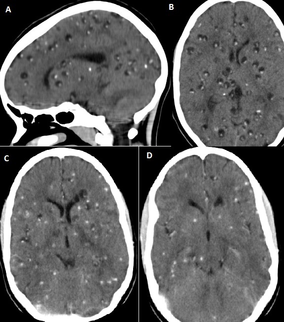 Neurocisticercosis