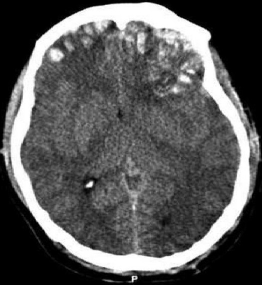 Contusión cerebral hemorrágica