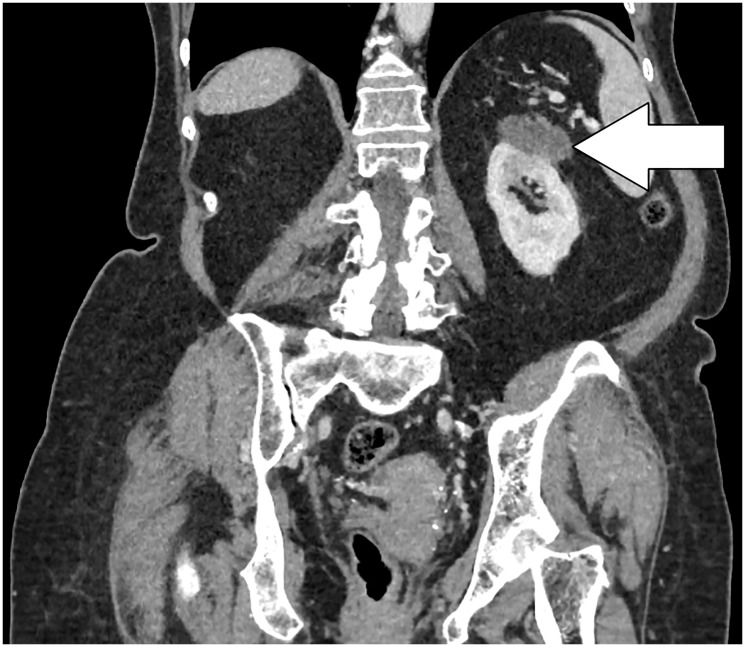 Oncocitoma renal