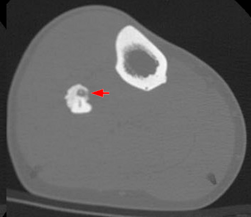 Osteoma osteoide