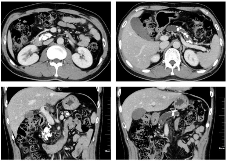Pancreatitis crónica