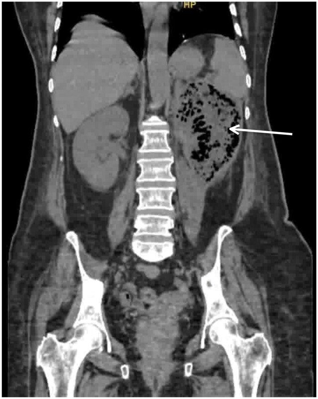 Pielonefritis enfisematosa