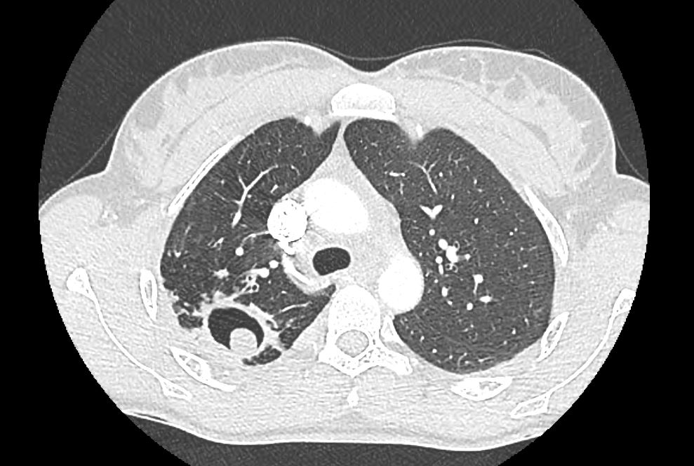 Aspergilosis pulmonar