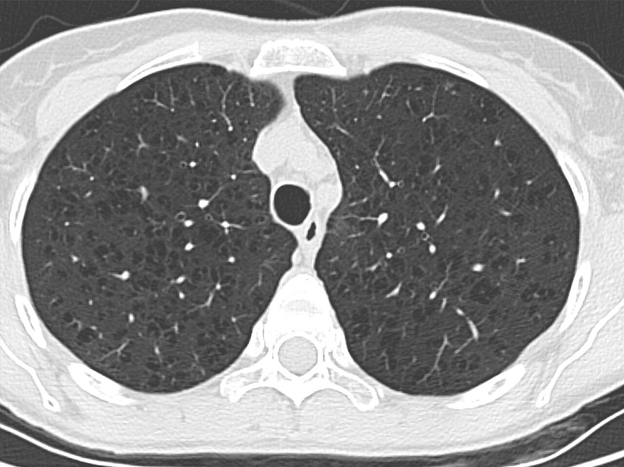 EPOC y enfisema pulmonar