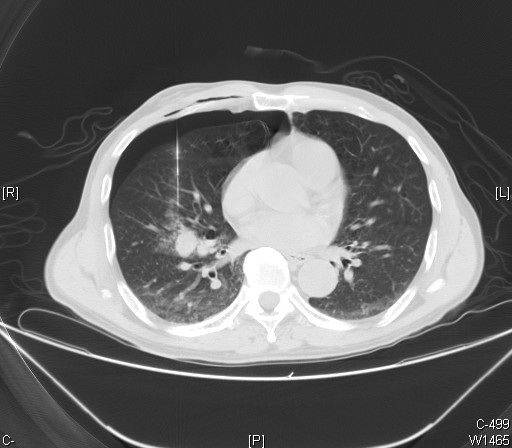 Hamartoma pulmonar